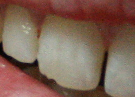 Trasig tand